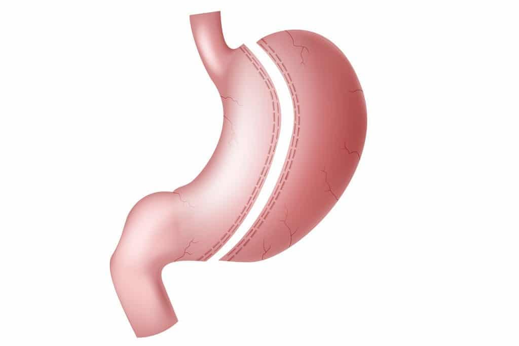 Gastric Sleeve Best Clinic Turkey – Complete Guide to Cost and Surgery Packages